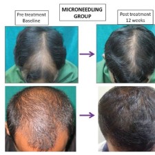 Remedy for hair loss