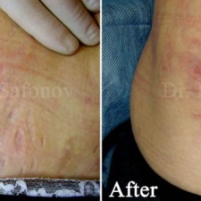 Reduce stretch mark by derma roller